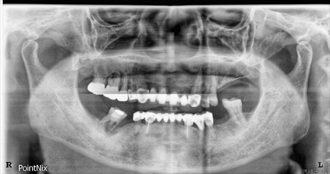 DENTIS Cleanlant Implant Uzun Dönem Verileri